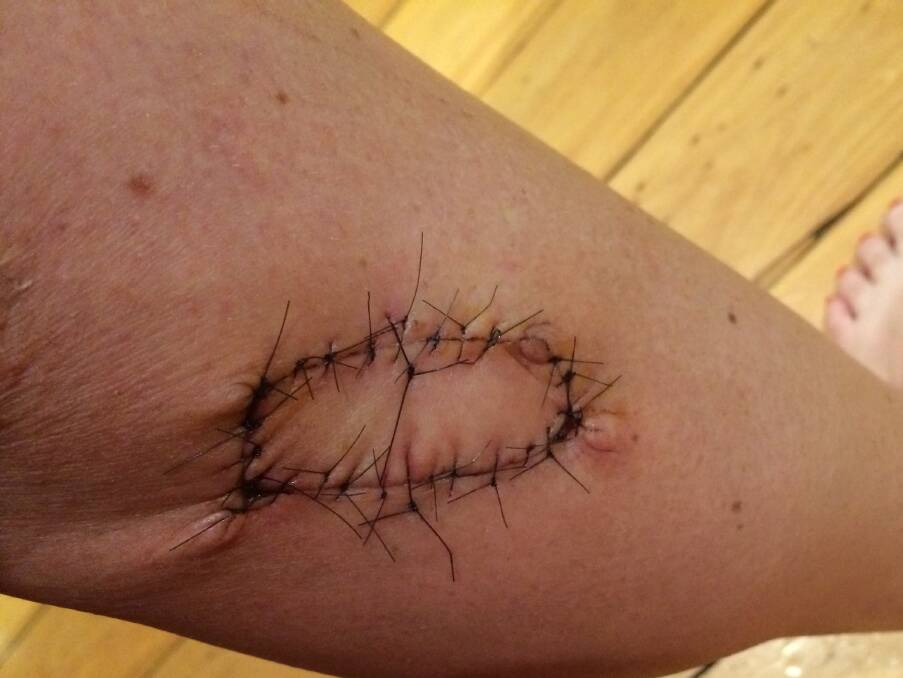 Shona Larkin had a stage 2 melonma cut out by her GP (skin doctor) after she noticed a mole on her calf had grown bigger. Picture: supplied by Shona Larkin 